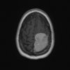 tumor1.jpg